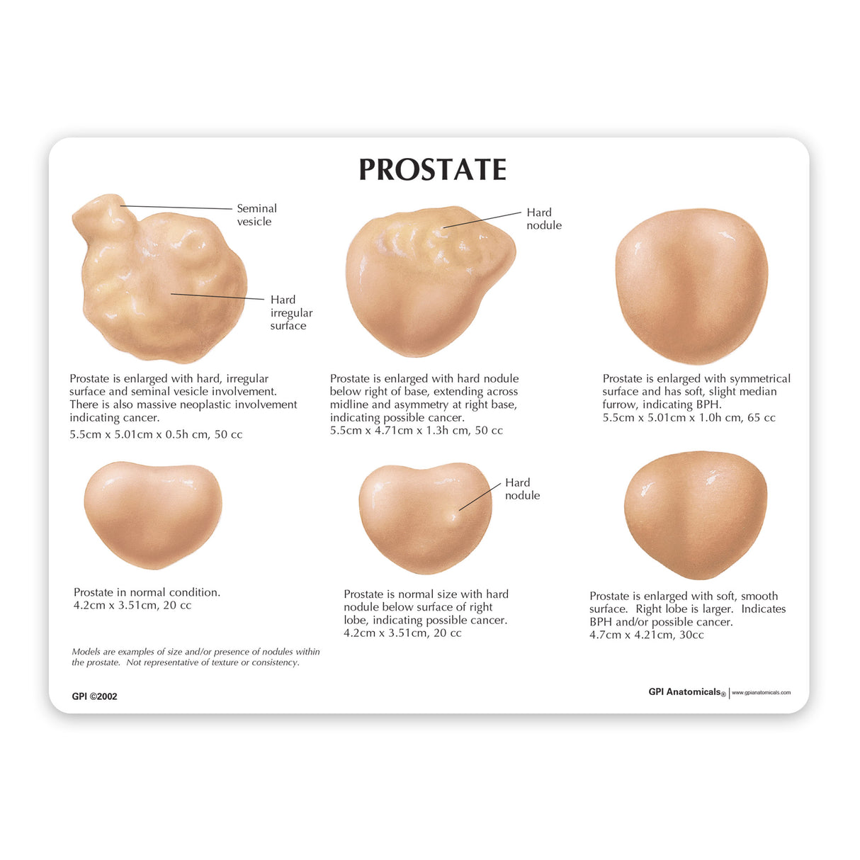 Prostate Set Education Card