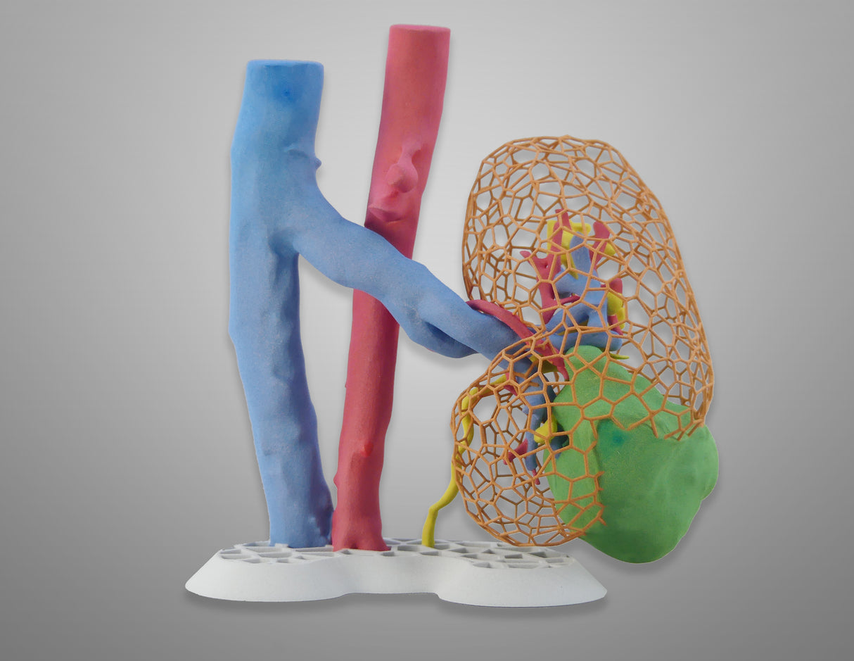 Lattice Right Kidney With Wilms Tumor (Nephroblastoma) - Male, 3 Years