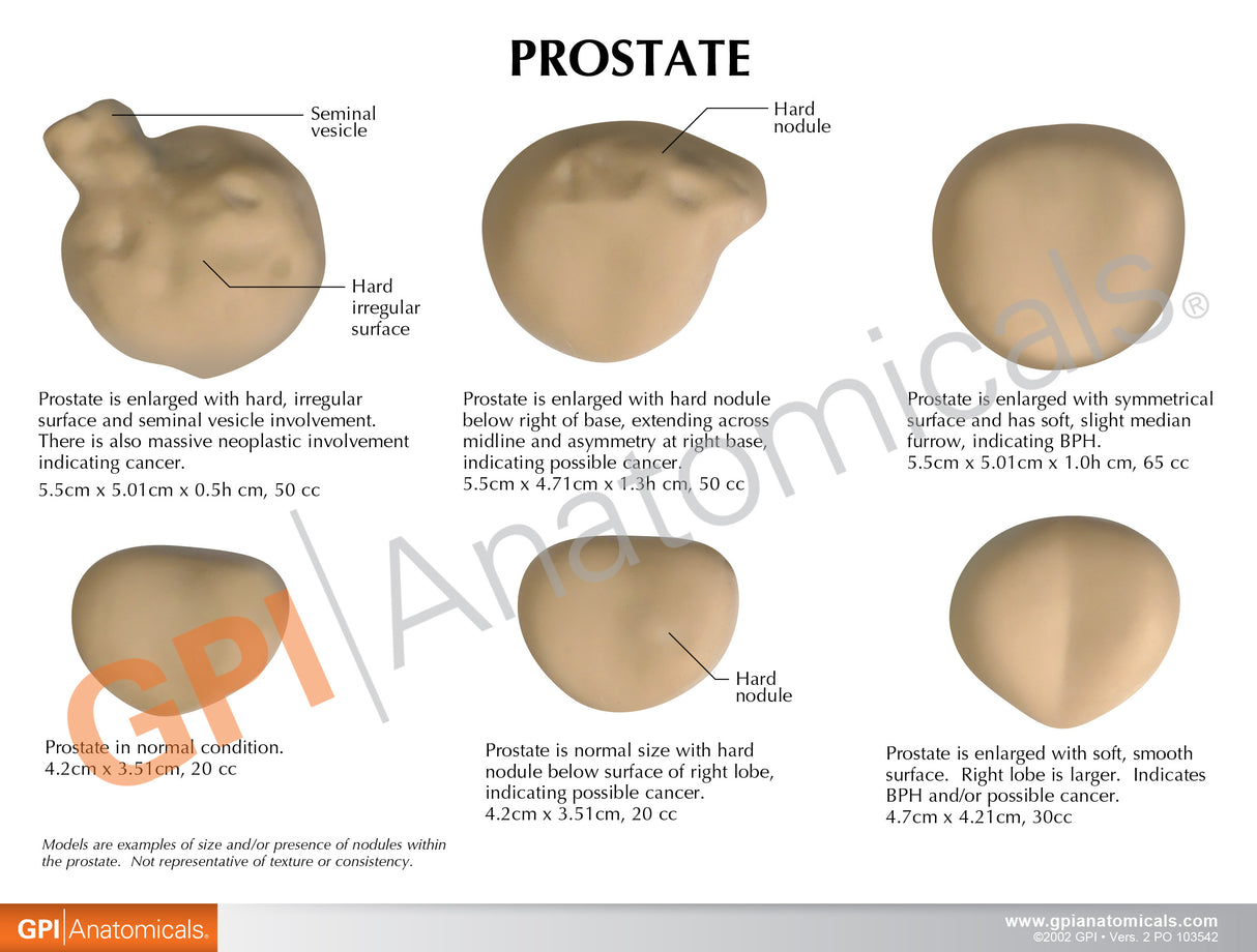 Prostate with Conditions Model Set