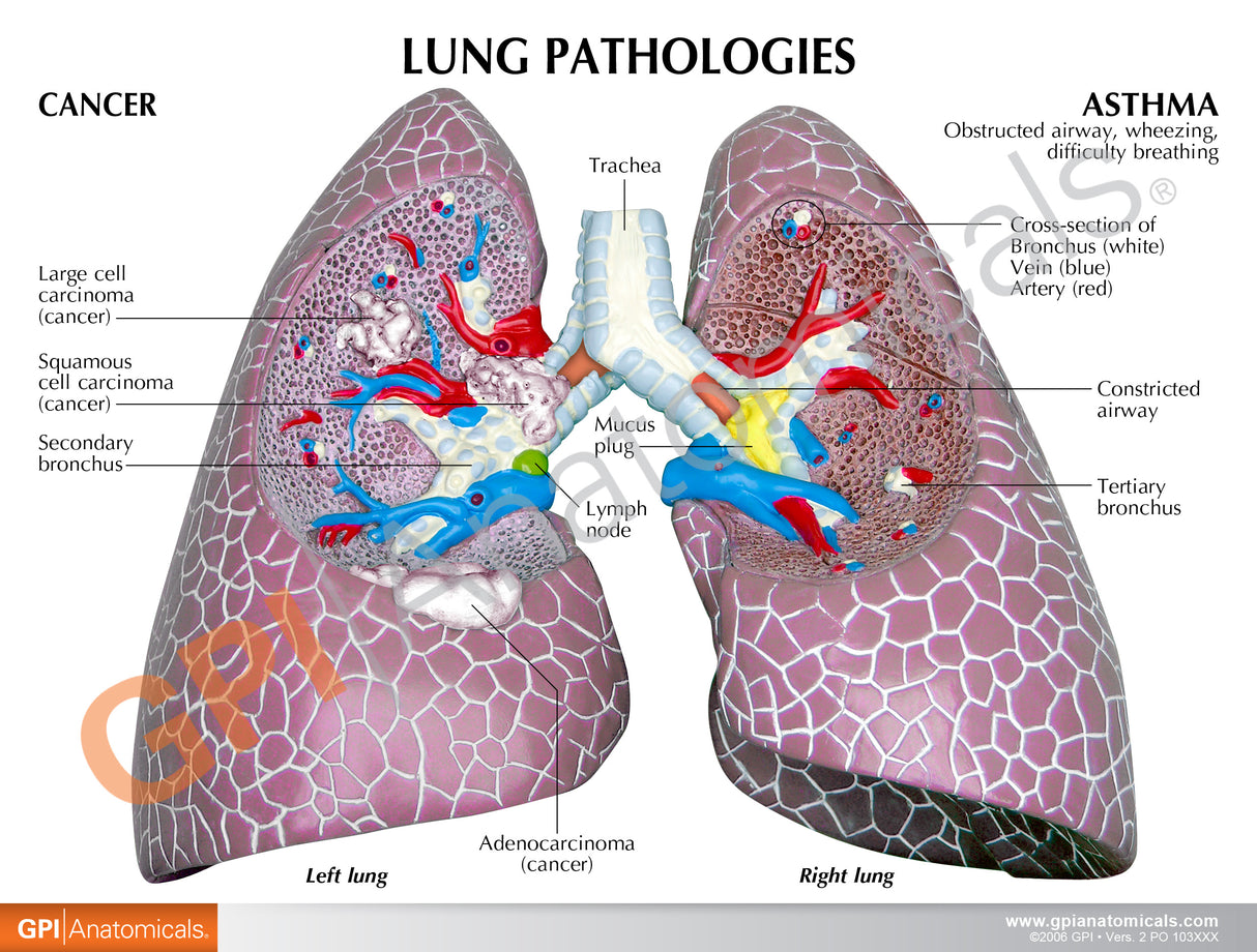 Lung Cancer Education Card