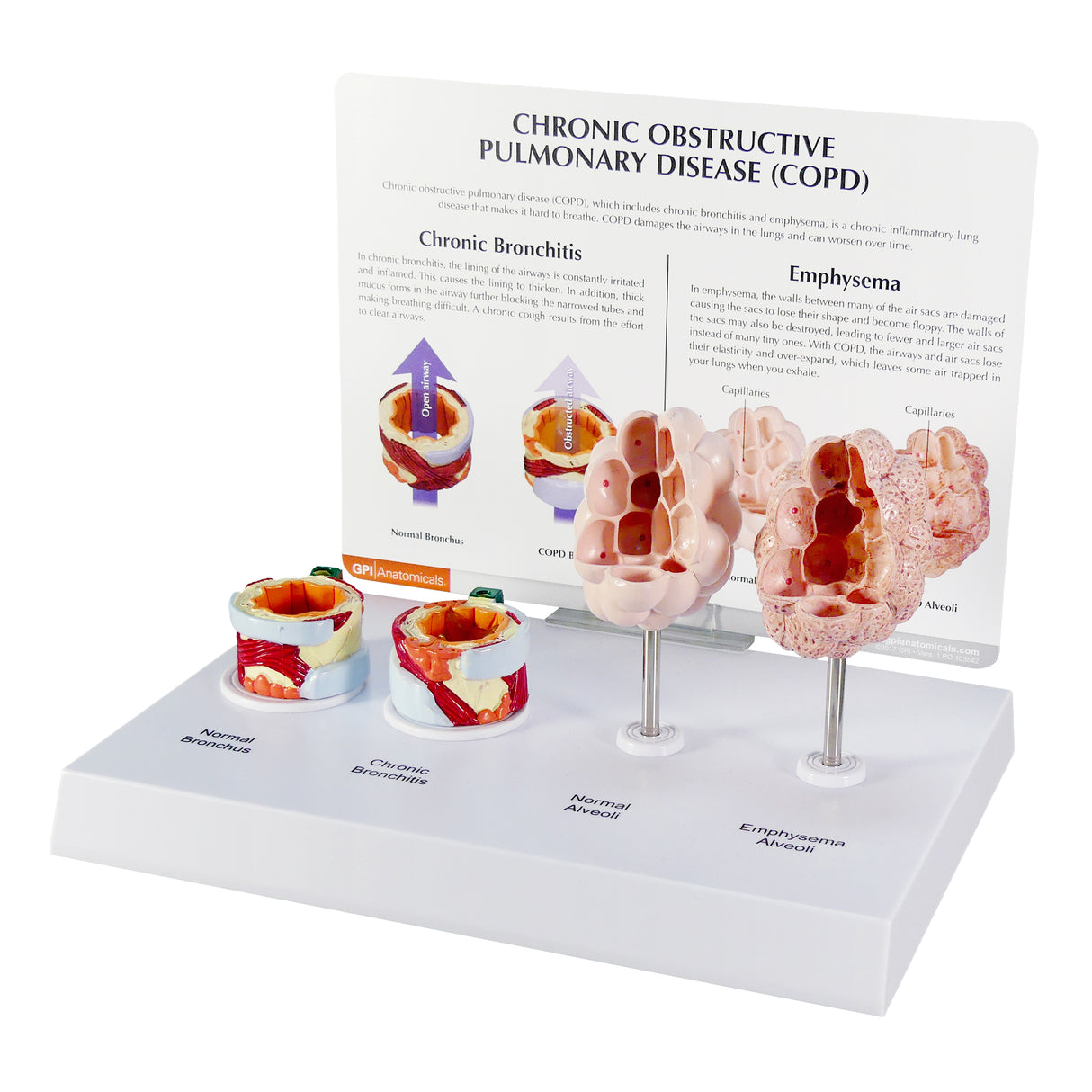 Respiratory System Model with Chronic Obstructive Pulmonary Disease (COPD)