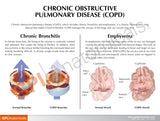 Respiratory System Model with Chronic Obstructive Pulmonary Disease (COPD)