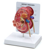 Normal and Diseased Kidney Model