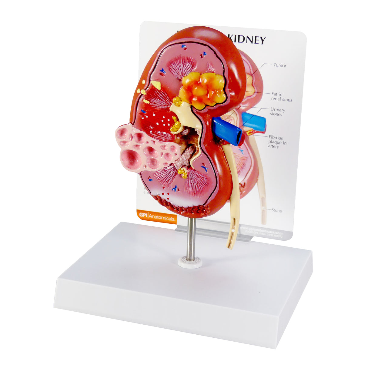 Normal and Diseased Kidney Model