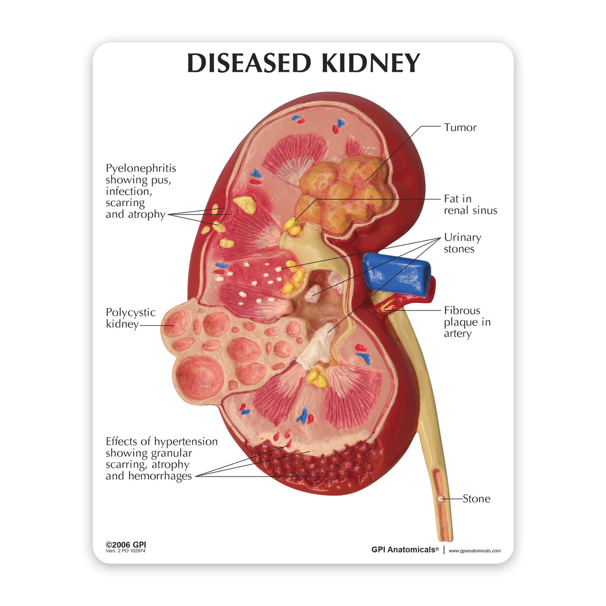 Normal and Diseased Kidney Model