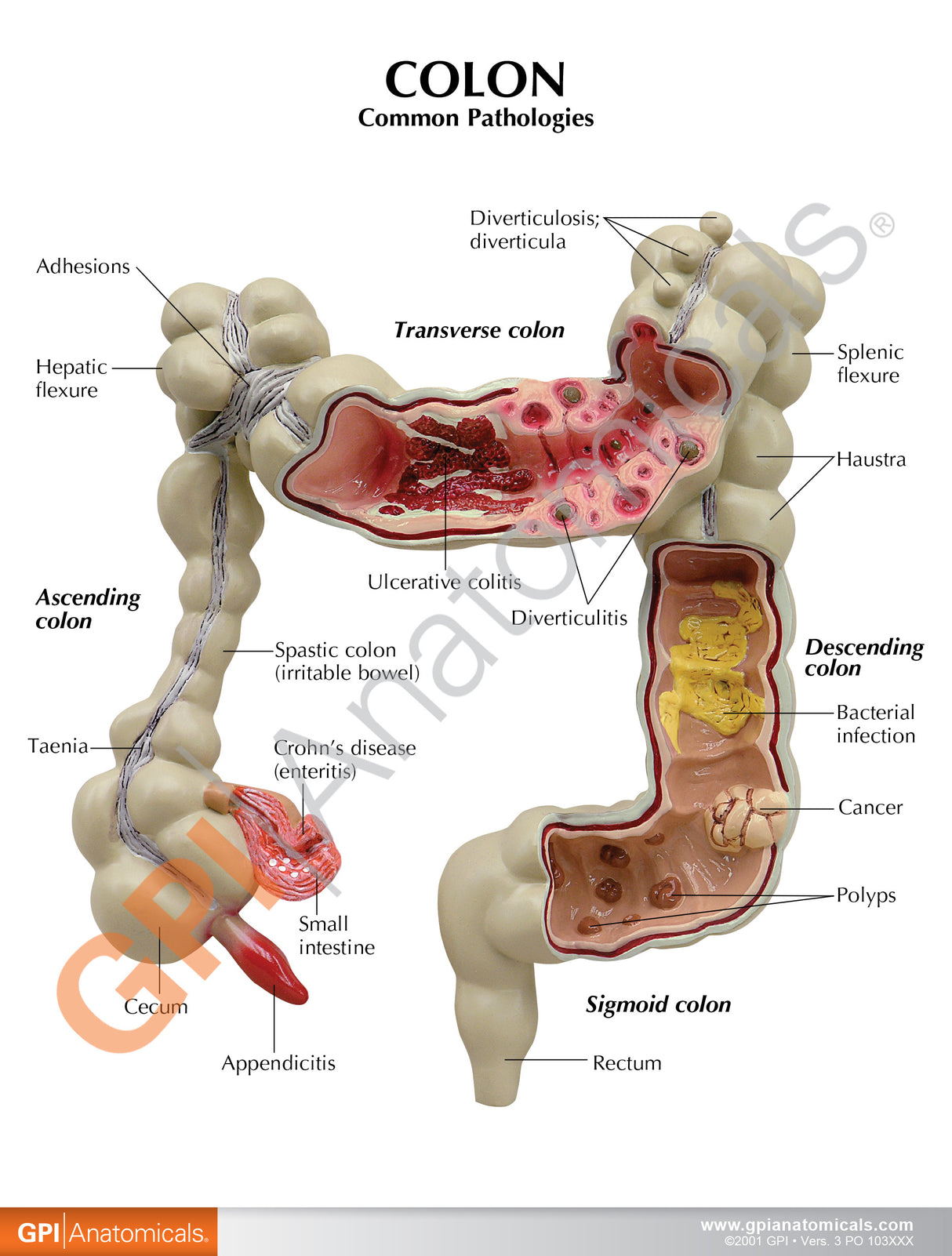 Colon Model with Common Pathologies