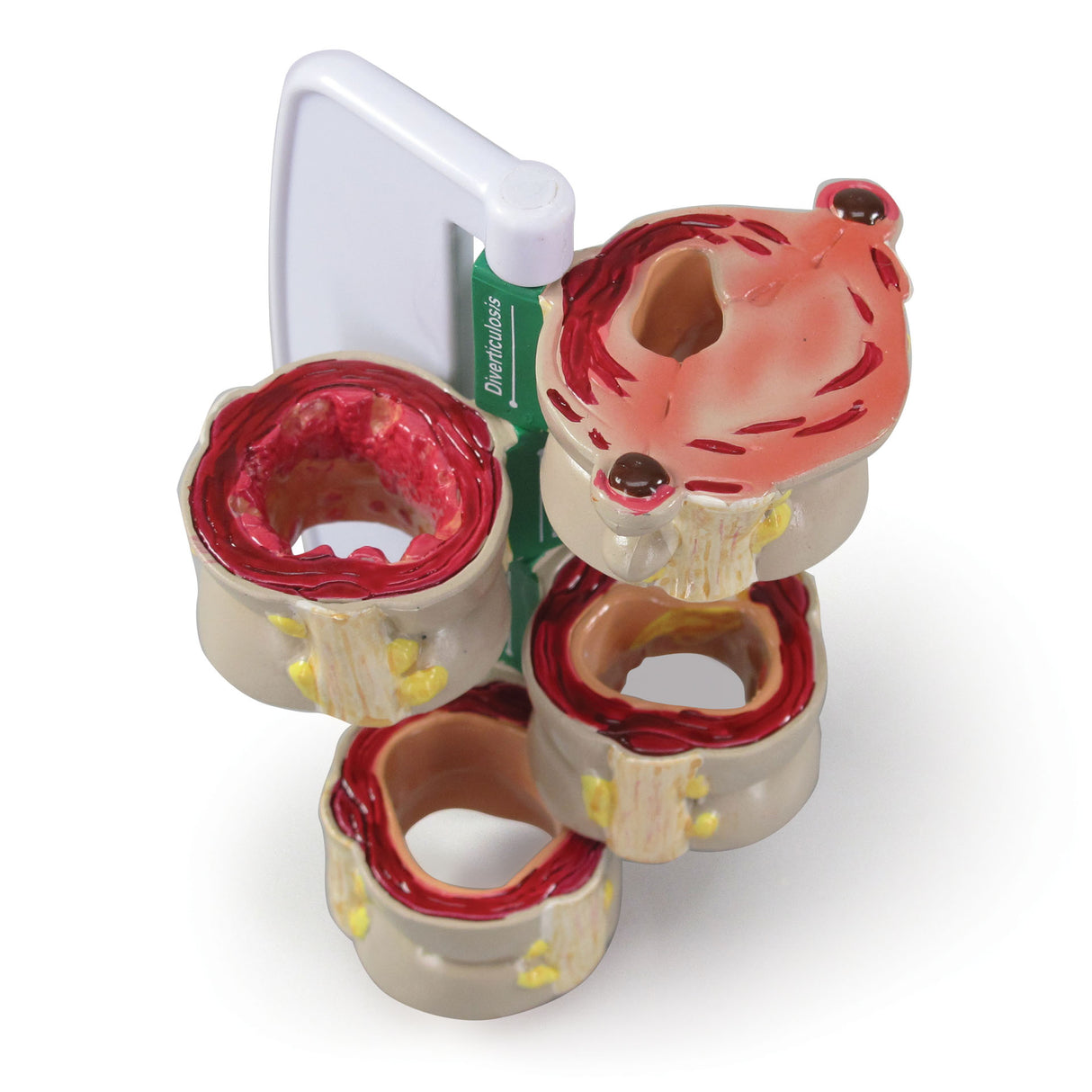 4-Piece Colon Model Set with Pathologies