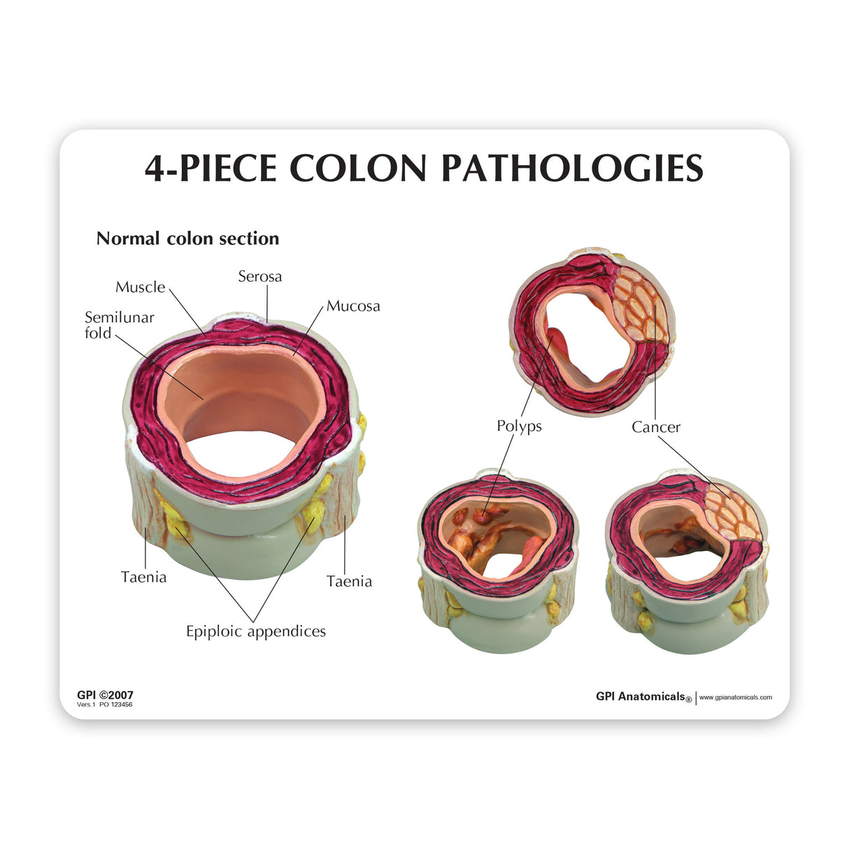 4-Piece Colon Model Set with Pathologies