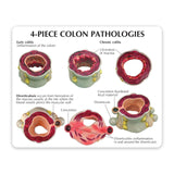 4-Piece Colon Model Set with Pathologies