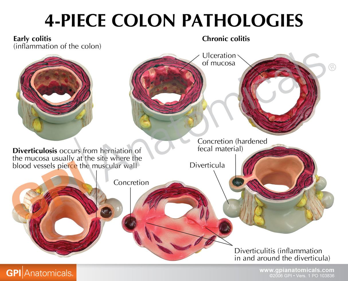 4-Piece Colon Set Education Card