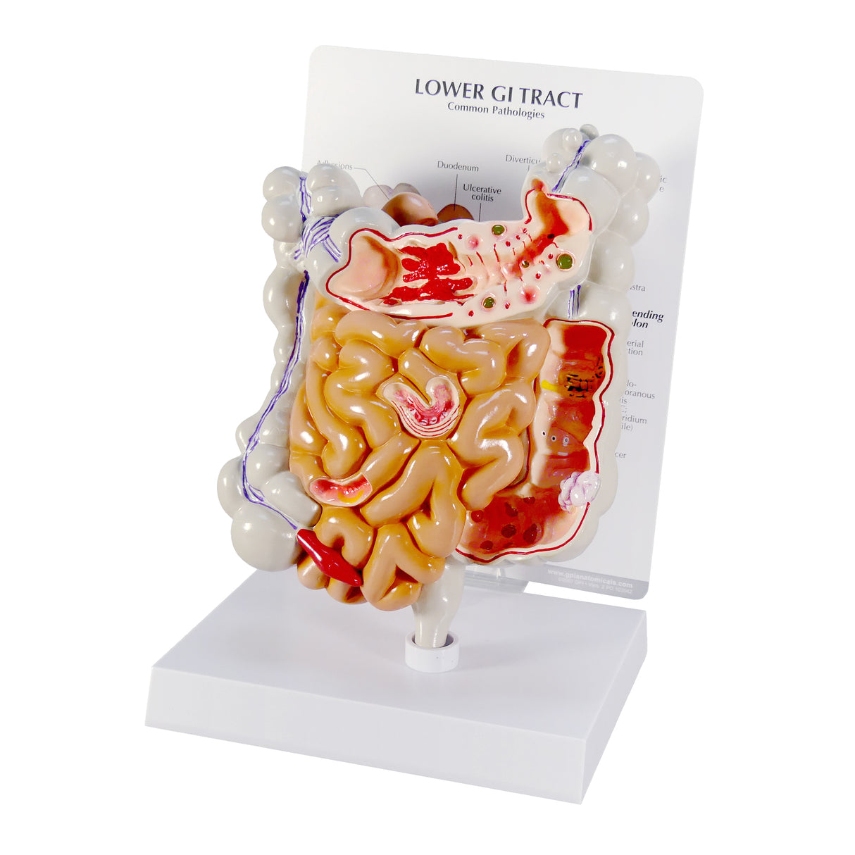 GI Tract Model with Common Pathologies