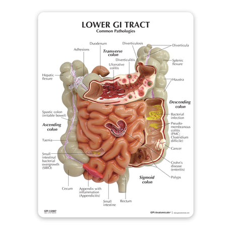 GI Tract Model with Common Pathologies