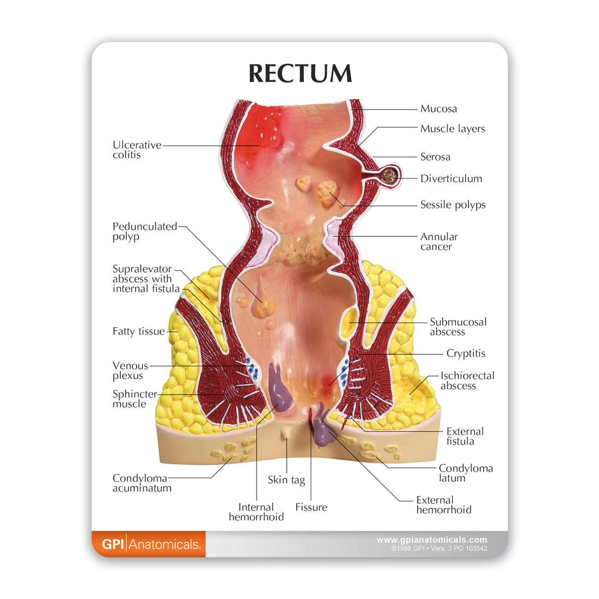 Rectum Model with Common Pathologies