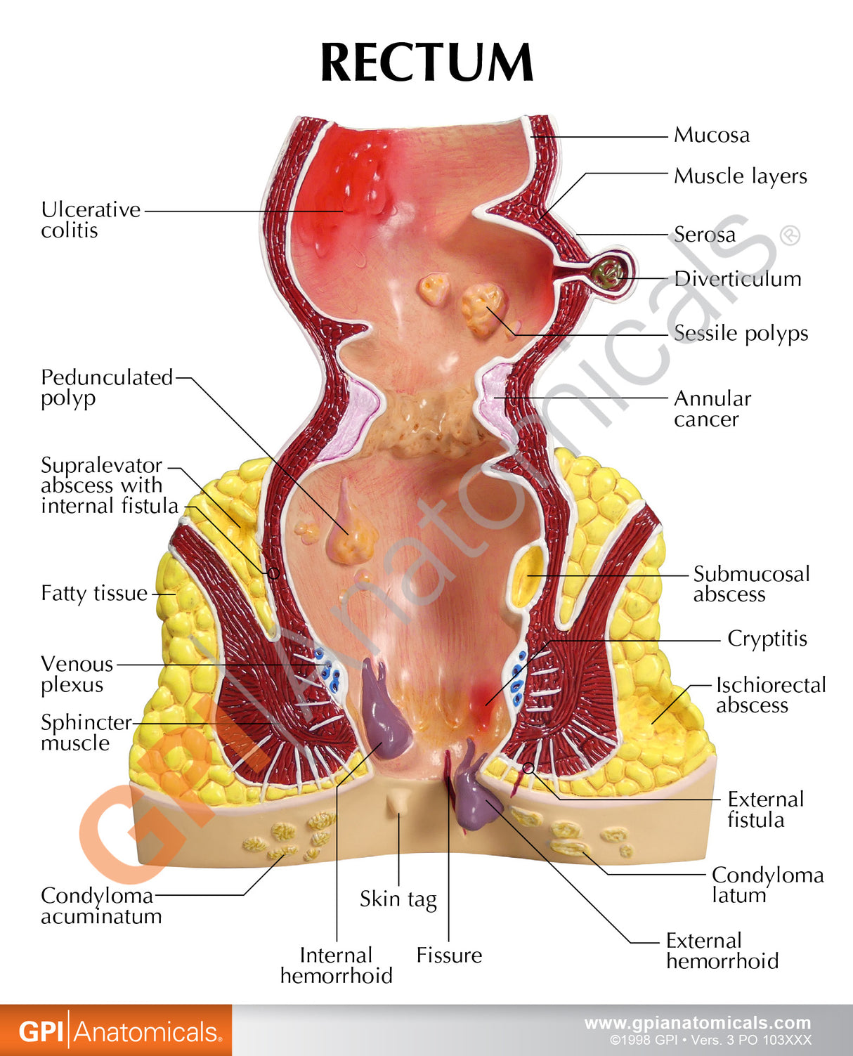 Rectum Model with Common Pathologies