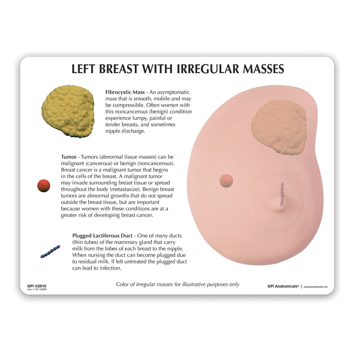 Left Breast Model with Irregular Masses