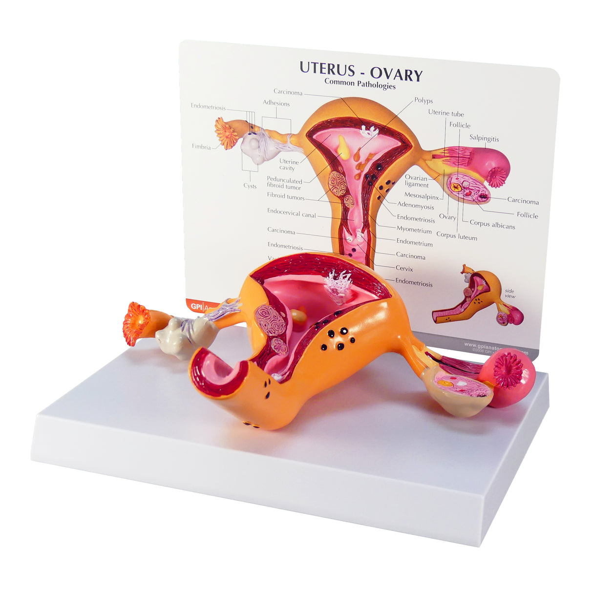 Uterus and Ovary Model