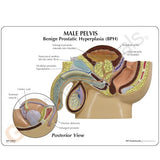 Male Pelvis Model with Benign Prostatic Hyperplasia (BPH)