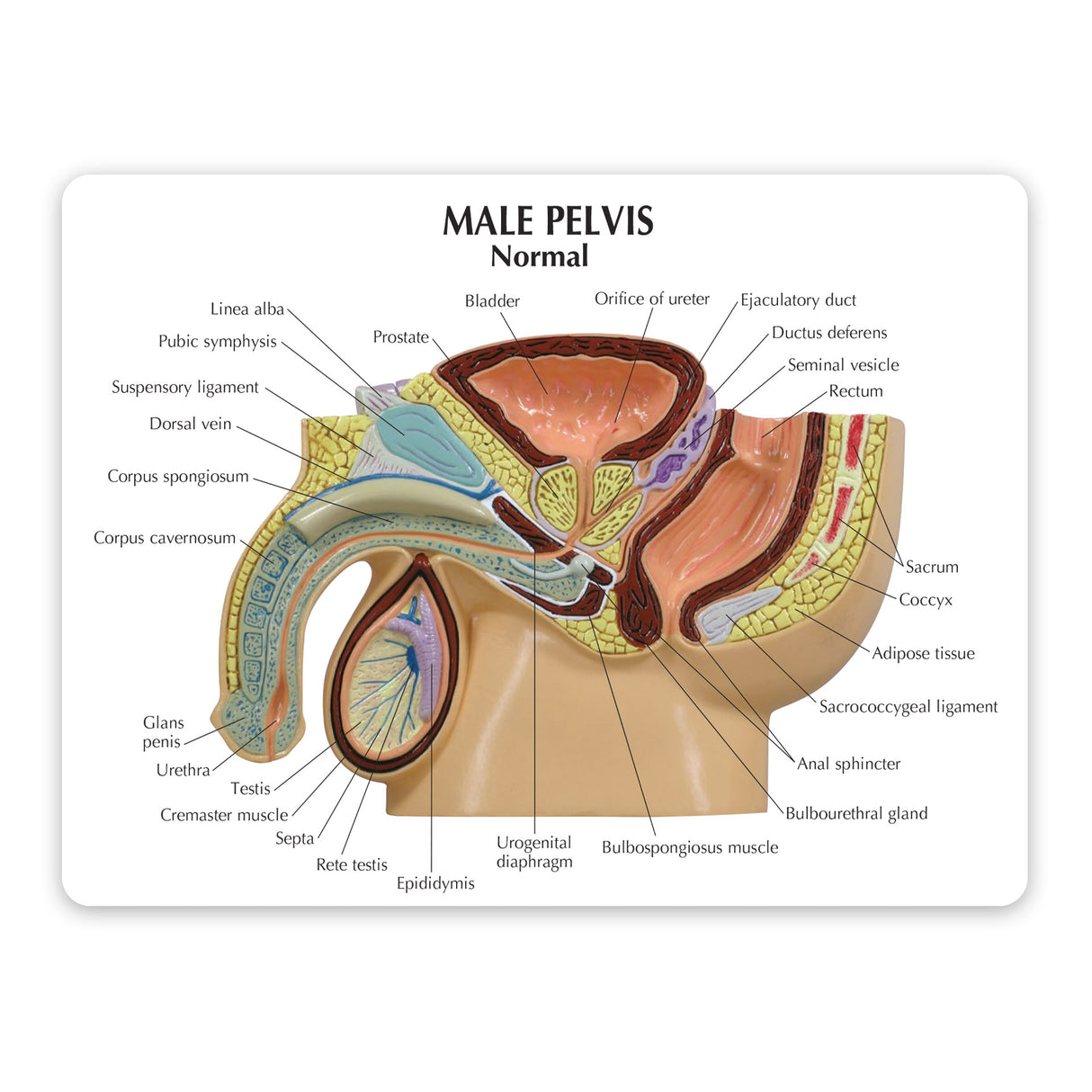 Male Pelvis Model with Benign Prostatic Hyperplasia (BPH)