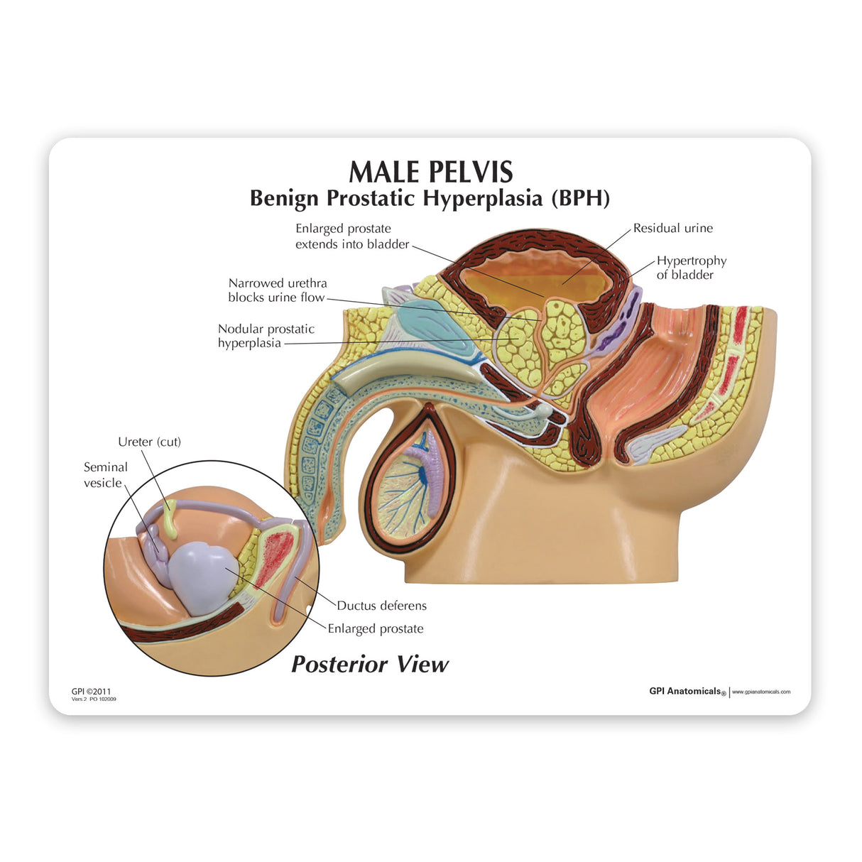 Male Pelvis Model with Benign Prostatic Hyperplasia (BPH)