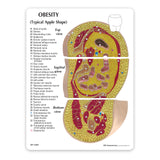 Obesity Model