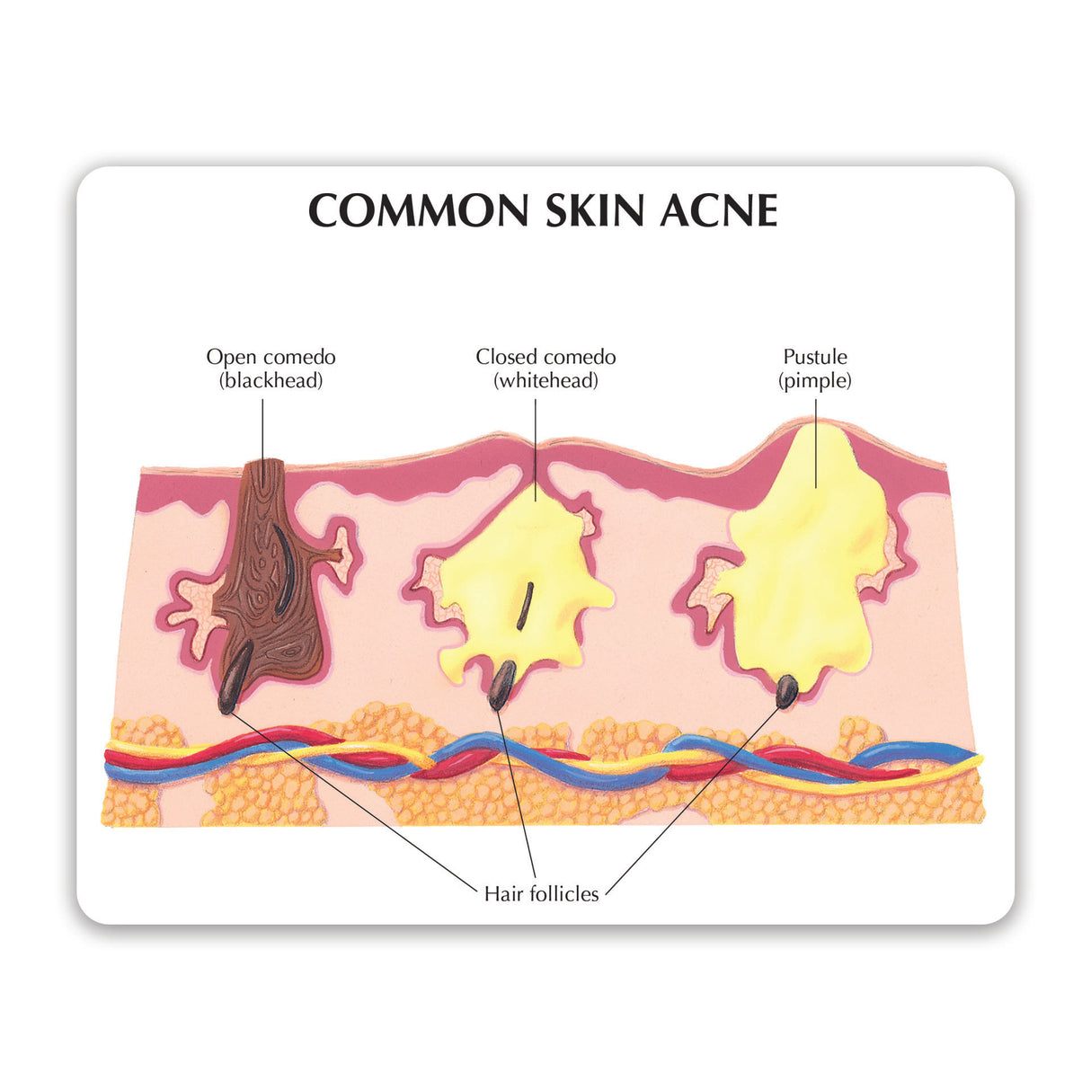 Skin Acne Model