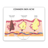 Skin Acne Education Card