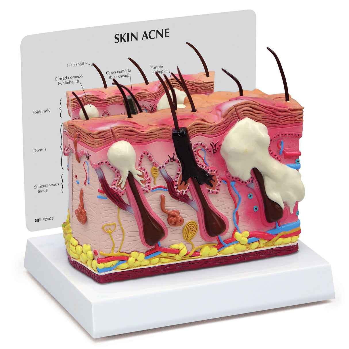 Skin Acne Cross-Section Model