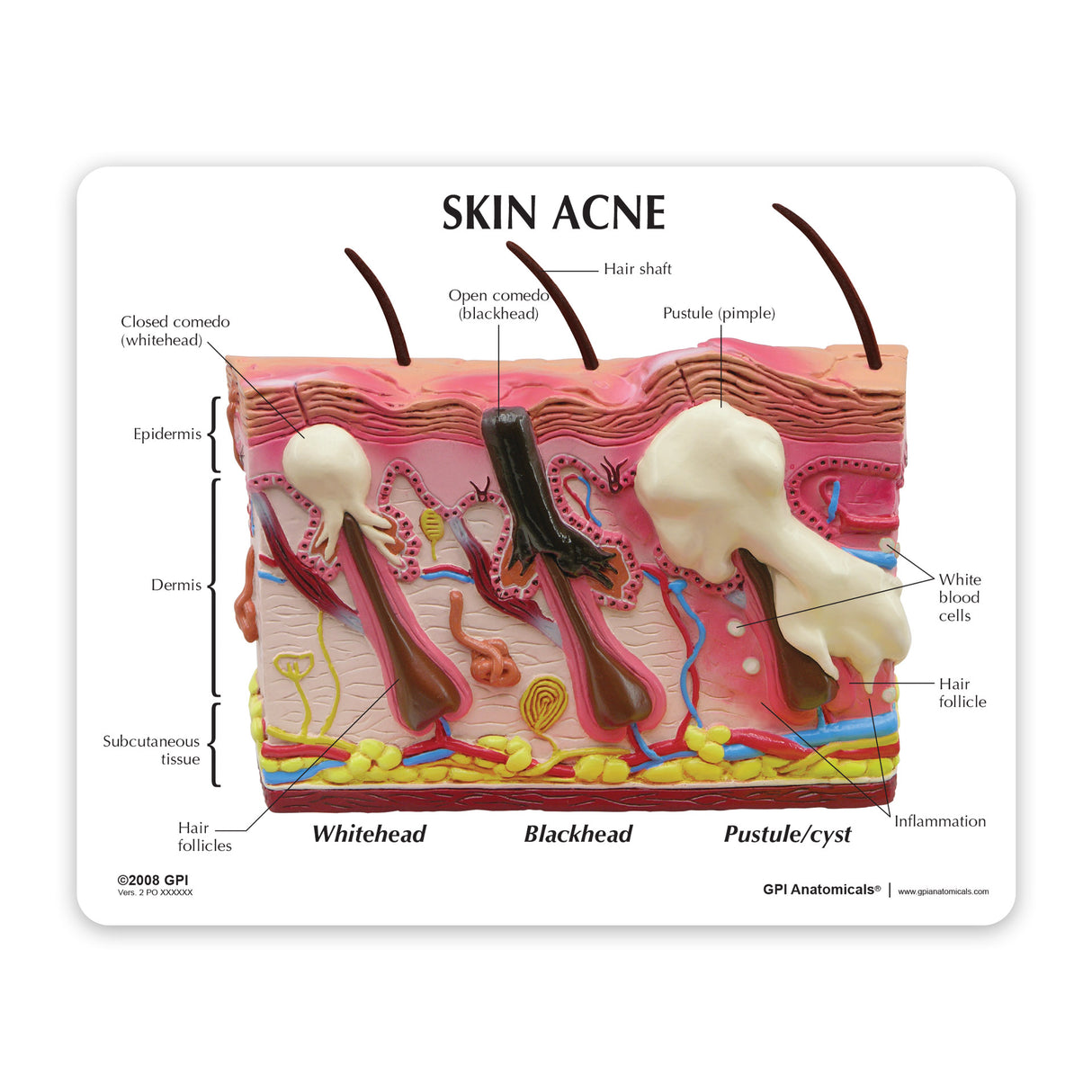 Skin Acne Cross-Section Model