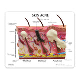 Skin Acne Cross-Section Education Card