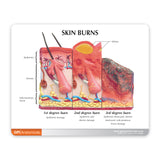 Skin Burn Education Card