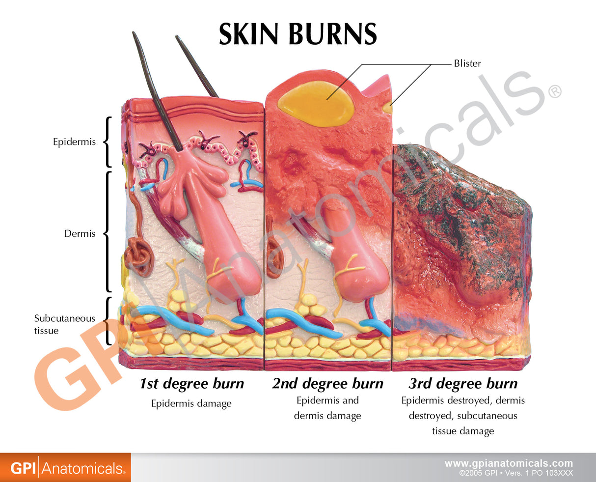 Skin Burn Education Card