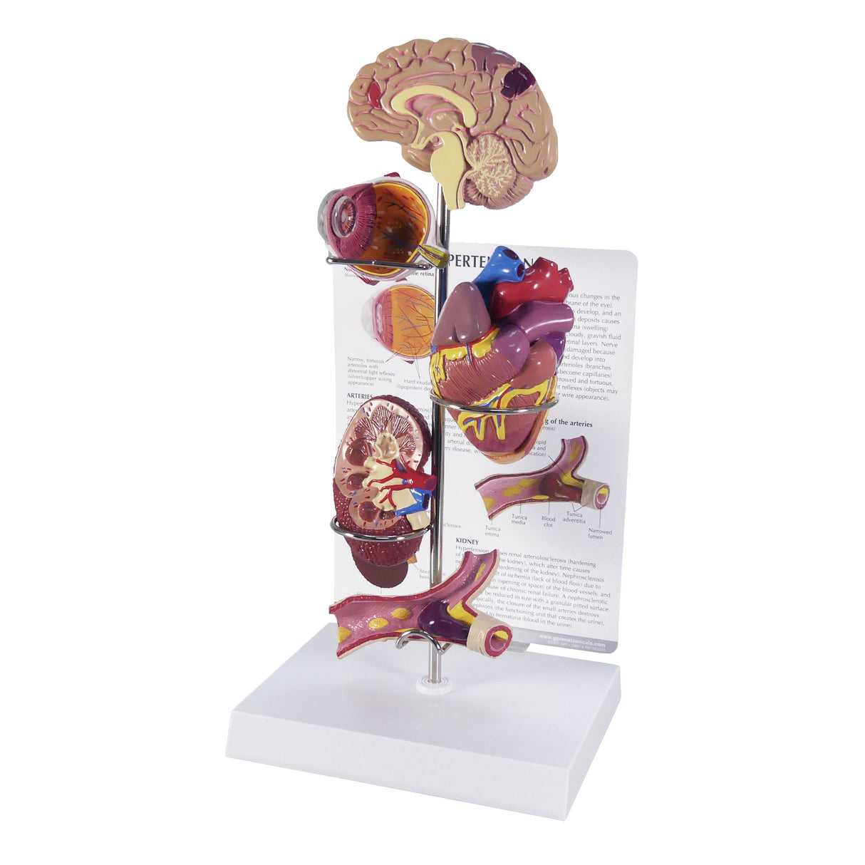 Hypertension Model Set