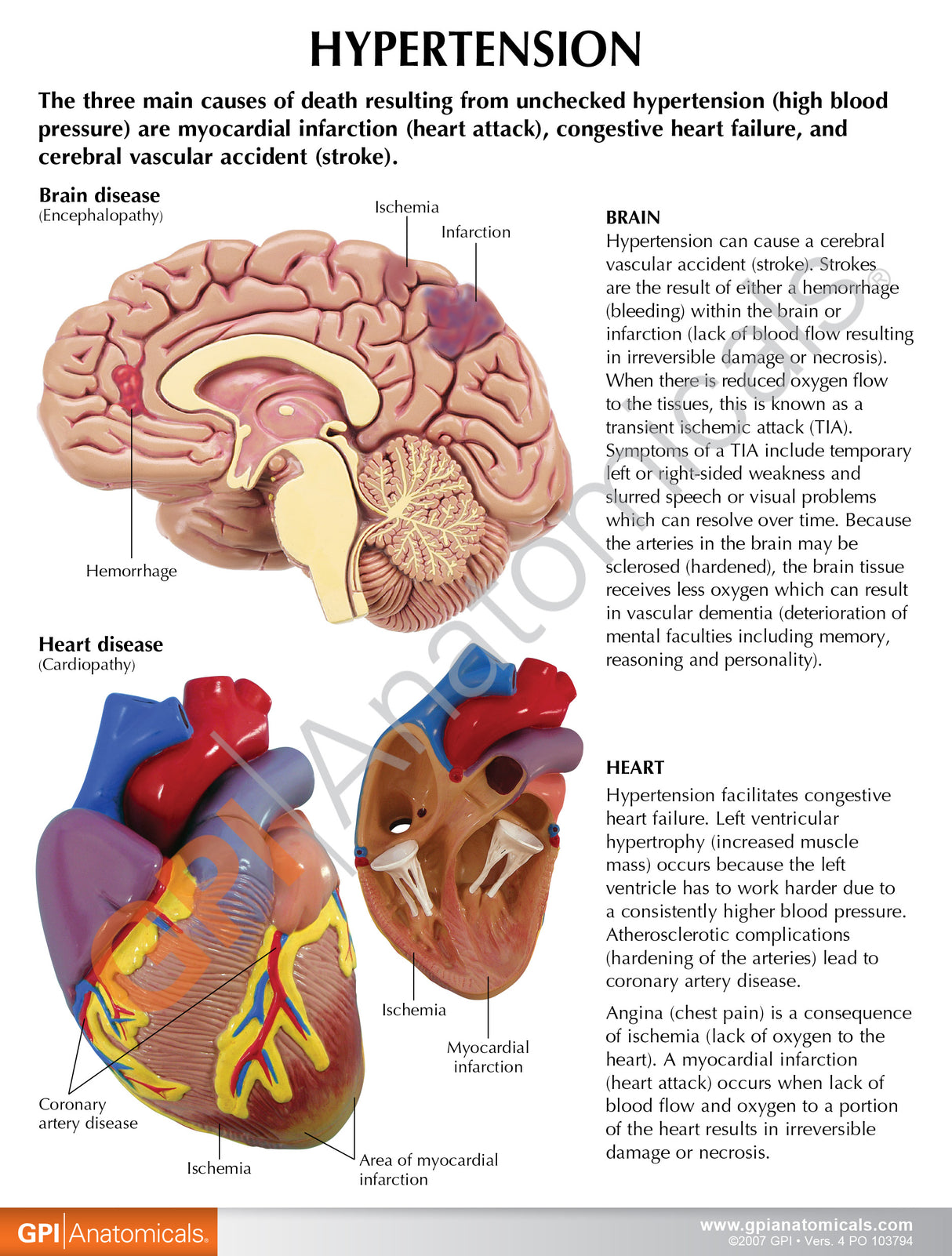 Hypertension Model Set