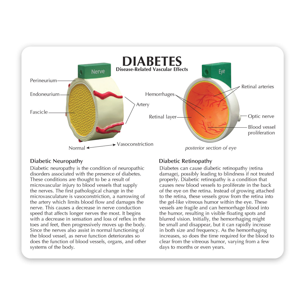 4-Piece Diabetes Model