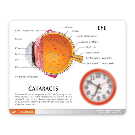 Cataract Eye Model