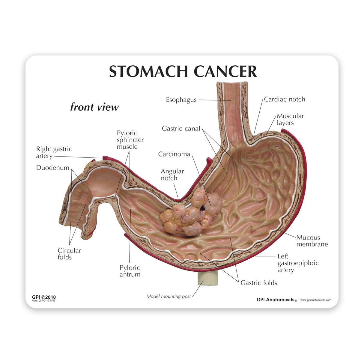 Stomach Cancer Education Card