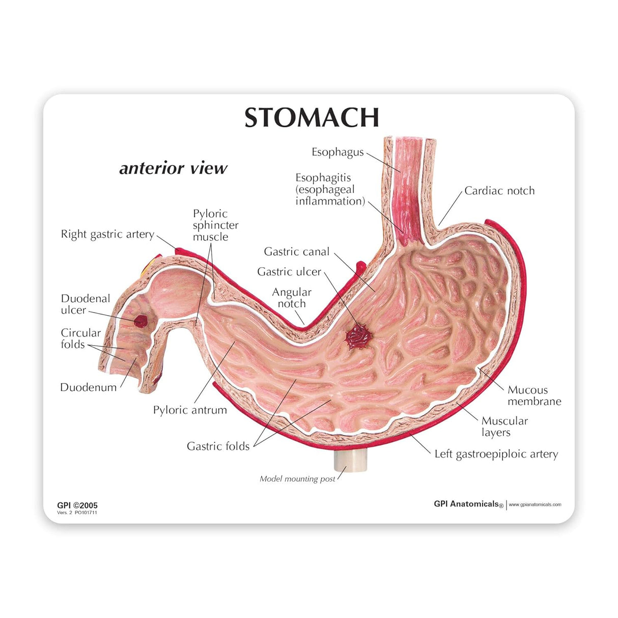 Stomach Model with Ulcers