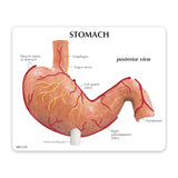 Stomach Model with Ulcers