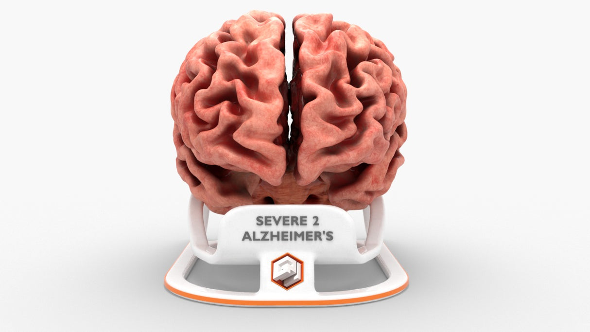 Adult Brain With Alzheimer’s Disease, Severe 2