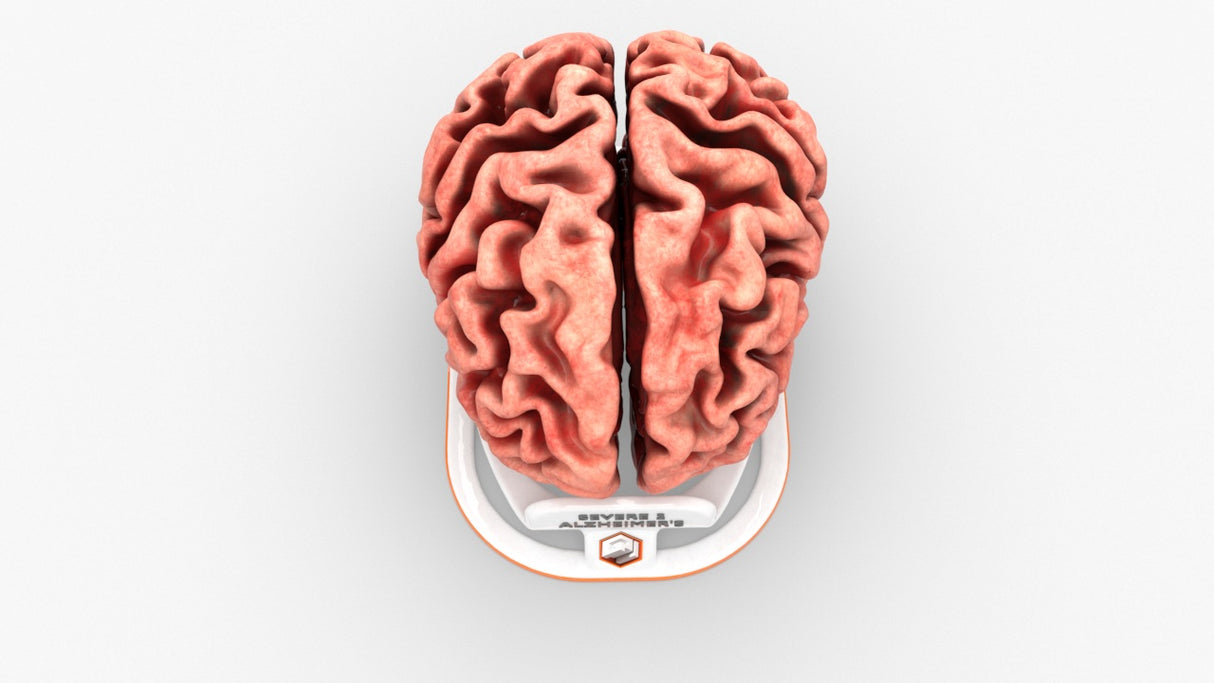 Adult Brain With Alzheimer’s Disease, Severe 2