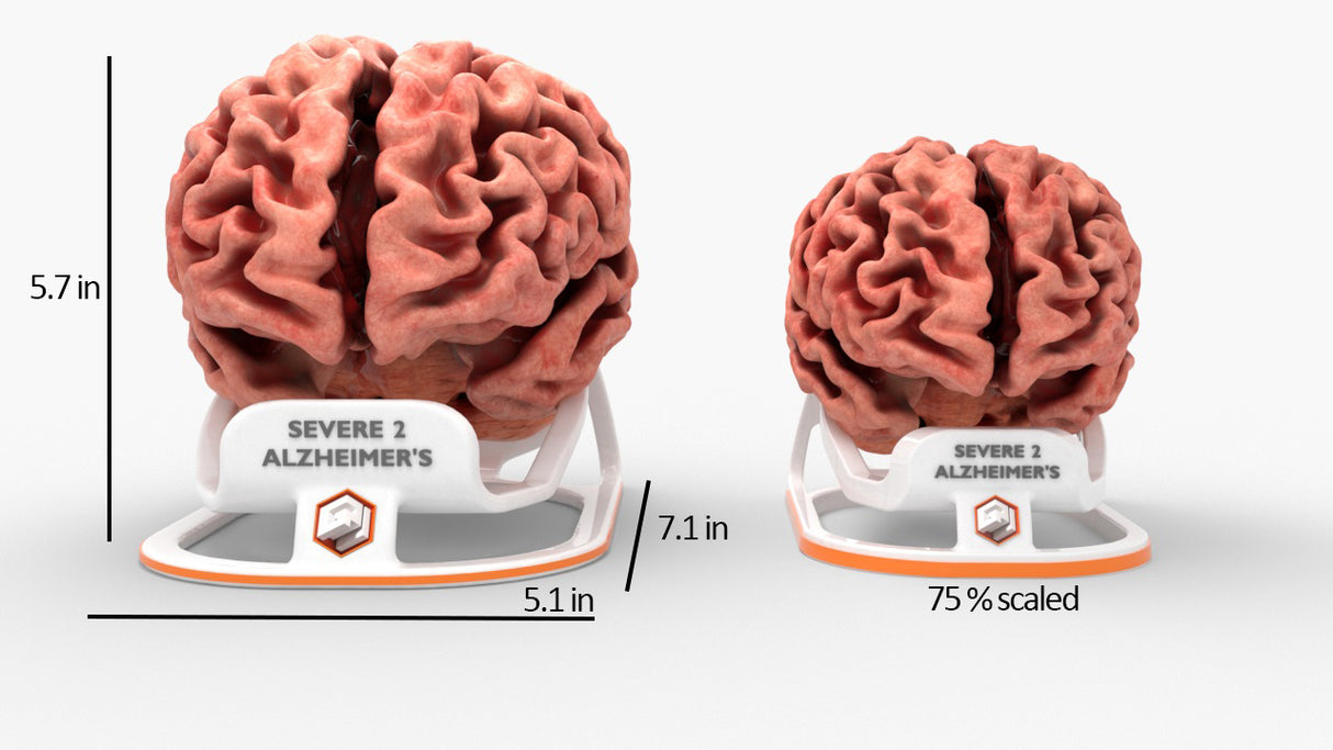 Adult Brain With Alzheimer’s Disease, Severe 2