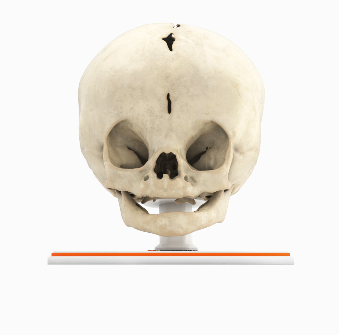 Infant Skull With Bilateral Craniosynostosis of the Coronal Suture - Female, 5 Months