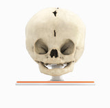 Infant Skull With Bilateral Craniosynostosis of the Coronal Suture - Female, 5 Months