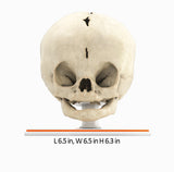 Infant Skull With Bilateral Craniosynostosis of the Coronal Suture - Female, 5 Months