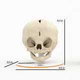 Infant Skull With Bilateral Craniosynostosis of the Coronal Suture - Female, 5 Months