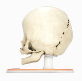 Infant Skull With Bilateral Craniosynostosis of the Coronal Suture - Female, 5 Months