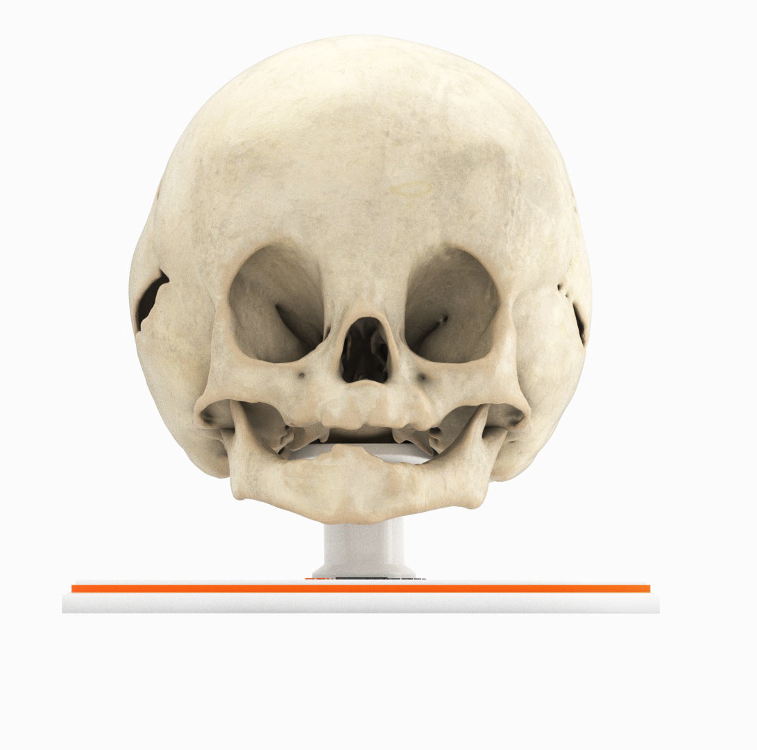 Infant Skull With Bilateral Craniosynostosis of the Lambdoid Suture - Male, 8 Months