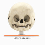 Infant Skull With Bilateral Craniosynostosis of the Lambdoid Suture - Male, 8 Months