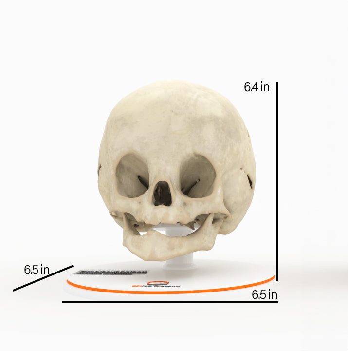 Infant Skull With Bilateral Craniosynostosis of the Lambdoid Suture - Male, 8 Months