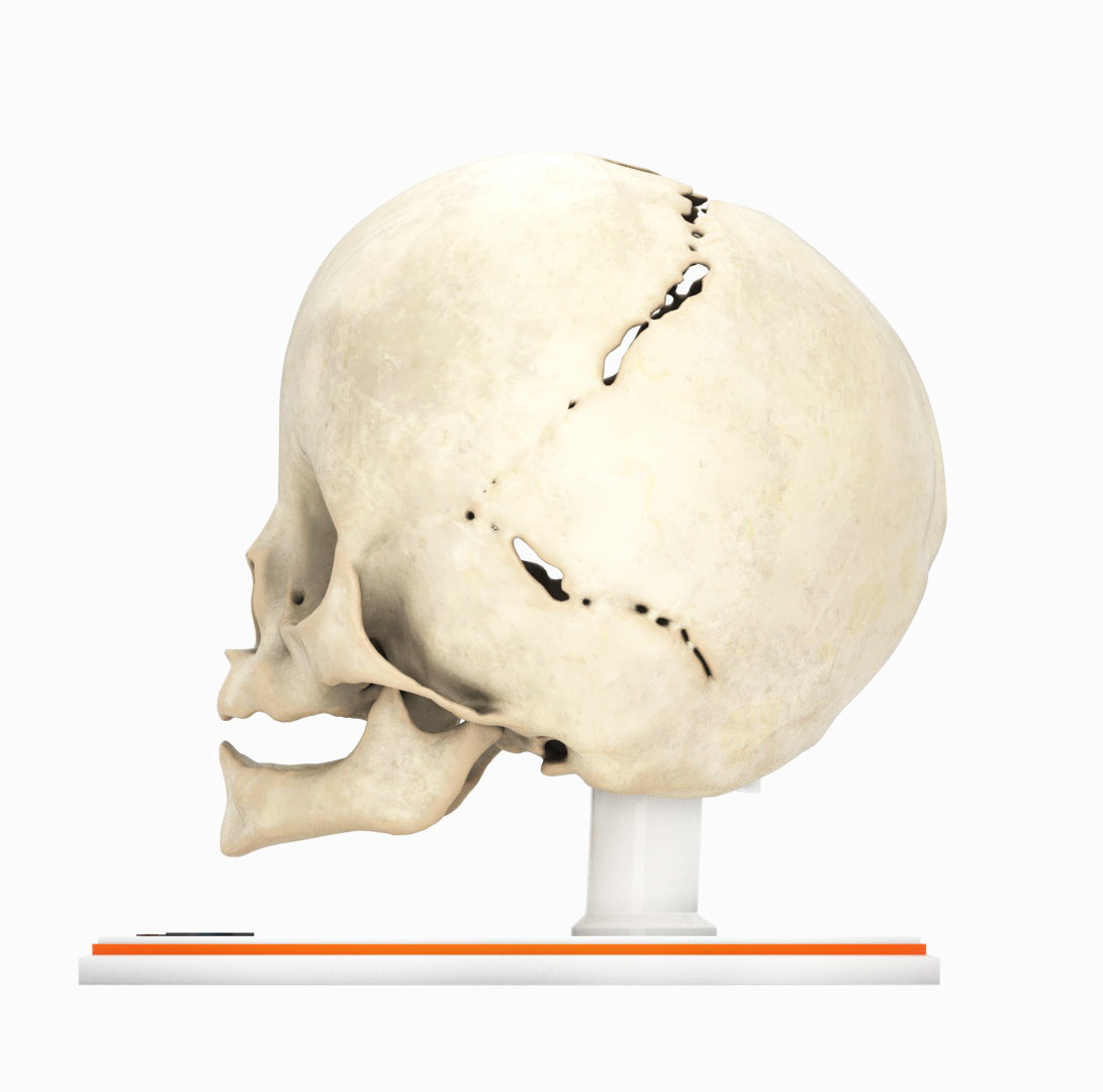 Infant Skull With Bilateral Craniosynostosis of the Lambdoid Suture - Male, 8 Months